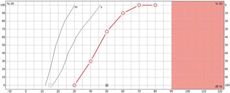 Speech Audiometry: An Introduction .